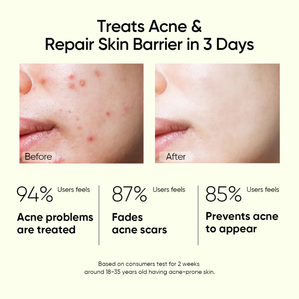 2% Salicylic Acid Serum Acne Treatment & Pore Clearing
