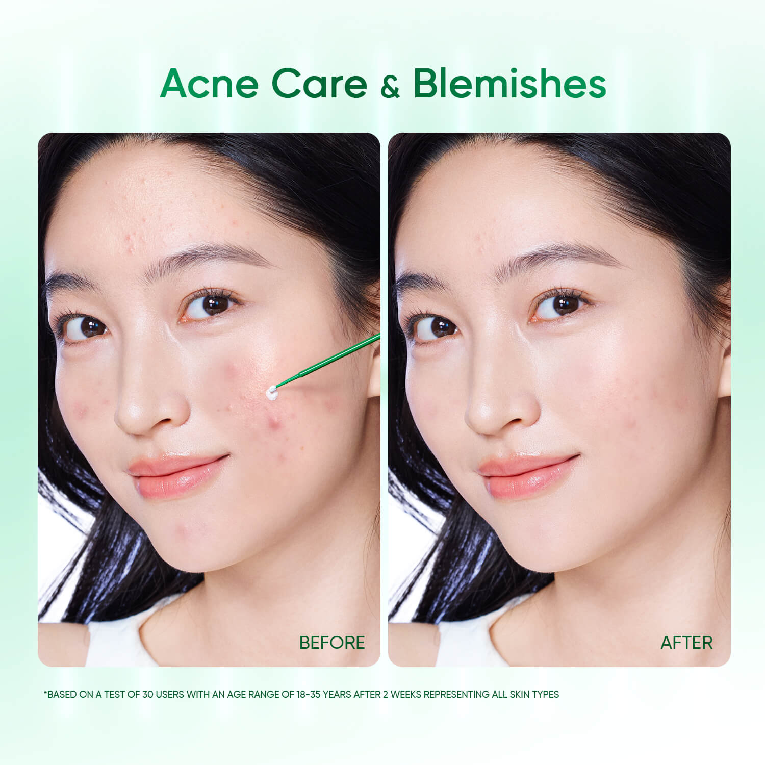 Acne Drying Lotion Overnight Spot Treatment